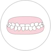 Anterior crossbite