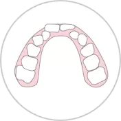 Individual tooth ectopia