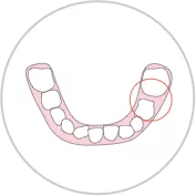 Narrow dental arches /
Dental crowding