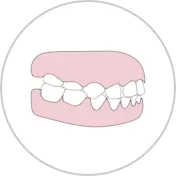 Posterior crossbite