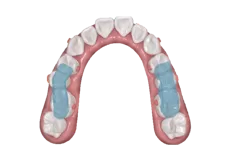 Mandibular Repositioning Device with Occlusal Splint