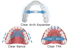 Palatal Device