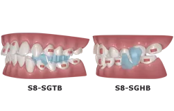 Device for Mandibular Advancement