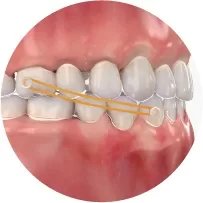 Class II Elastics