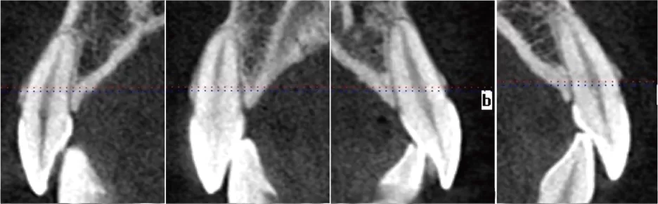 Prevent Bone Fenestration and Bone Dehiscence