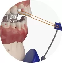 S16 Invisible Forwarding Elastics