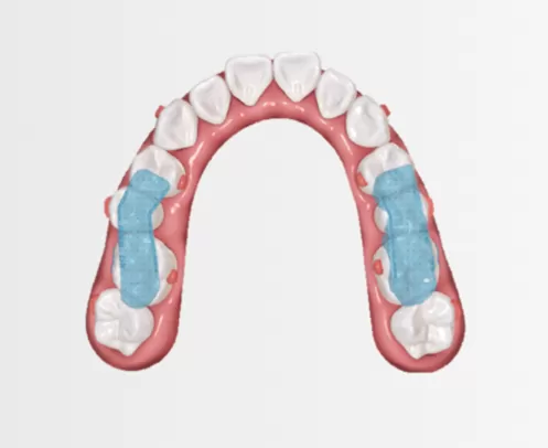 Mandibular Repositioning Device with Occlusal Splint