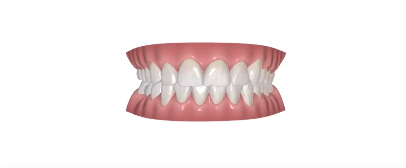 3D simulation treatment plan. cross bite