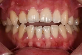 Intraoral photos