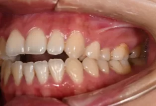 Intraoral photos