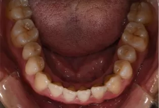 Intraoral photos