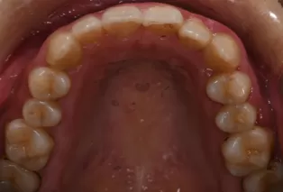 Intraoral photos