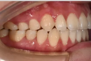 Intraoral photos after treatment