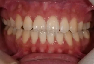 Intraoral photos after treatment