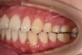 Intraoral photos after treatment