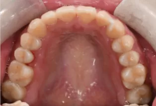 Intraoral photos after treatment