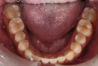 Intraoral photos after treatment