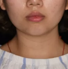 Facial photos before treatment