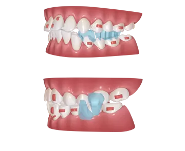 S8 Mandibular Repositioning Device for Mandibular Advancement