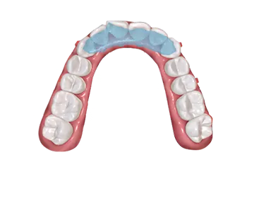 S9 Mandibular Repositioning Device with Bite Plane