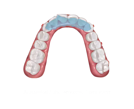 S9 Mandibular Repositioning Device with Bite Plane