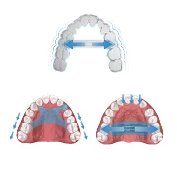 S11 Palatal Device