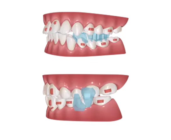 S8 Mandibular Repositioning Device for Mandibular Advancement