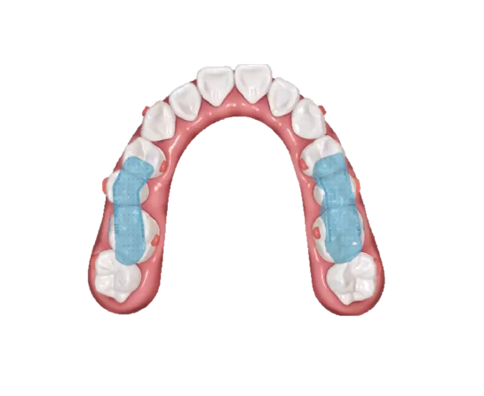 S10 Mandibular Repositioning Device with Occlusal Splint