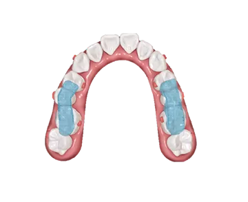 S10 Mandibular Repositioning Device with Occlusal Splint