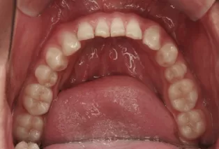 Intraoral photos