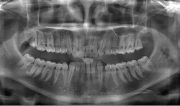 X-rays before treatment