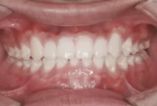 Intraoral photos