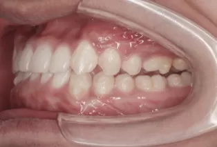 Intraoral photos