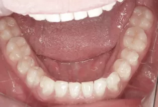 Intraoral photos