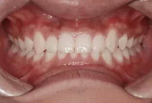 Intraoral photos after treatment