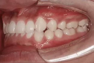 Intraoral photos after treatment