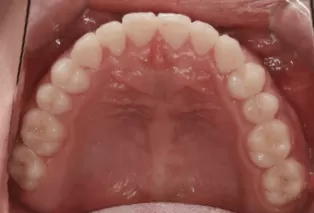 Intraoral photos after treatment