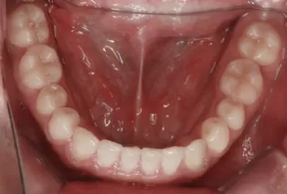 Intraoral photos after treatment