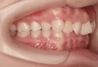 Intraoral photos