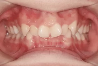 Intraoral photos