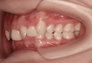 Intraoral photos