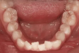 Intraoral photos