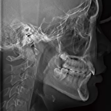 X-rays before treatment