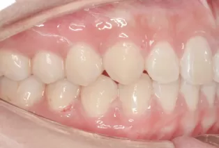 Intraoral photos after treatment