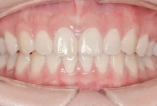 Intraoral photos after treatment