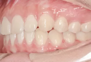 Intraoral photos after treatment