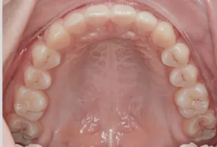 Intraoral photos after treatment