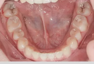 Intraoral photos after treatment