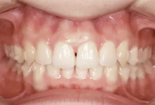 Intraoral photos