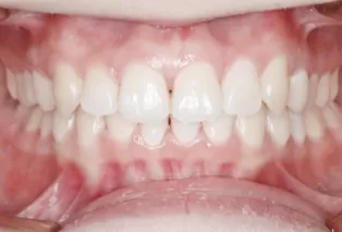 Intraoral photos after treatment